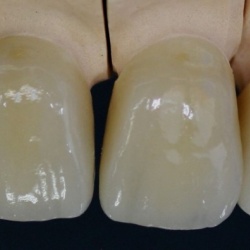 Zircones sur dents naturelles